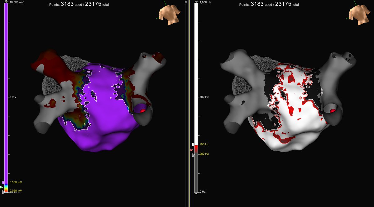 Had the opportunity to use the new ESI Omnipolar Near Field system this week! Exciting new technology to help differentiate far field vs near field signals based on frequency. Check out a couple representative images for our de novo PVI and redo PVI! #EPeeps #AFib