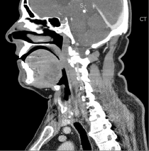 orthoEMpearls's tweet photo. Did you see this week’s case of a 45yo that presented to the ED with neck pain and trismus? #FOAMed #FOAMrad #EmergencyMed 

https://t.co/4hyAUIPE8b https://t.co/7OG1QNue1E