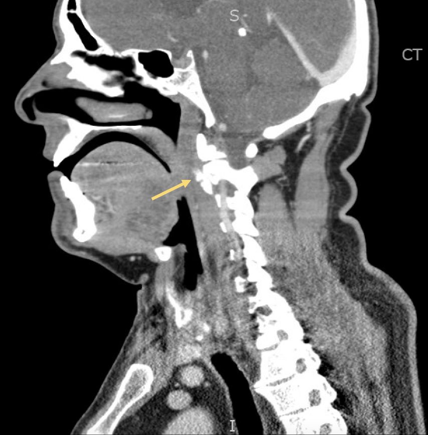orthoEMpearls's tweet photo. Did you see this week’s case of a 45yo that presented to the ED with neck pain and trismus? #FOAMed #FOAMrad #EmergencyMed 

https://t.co/4hyAUIPE8b https://t.co/7OG1QNue1E