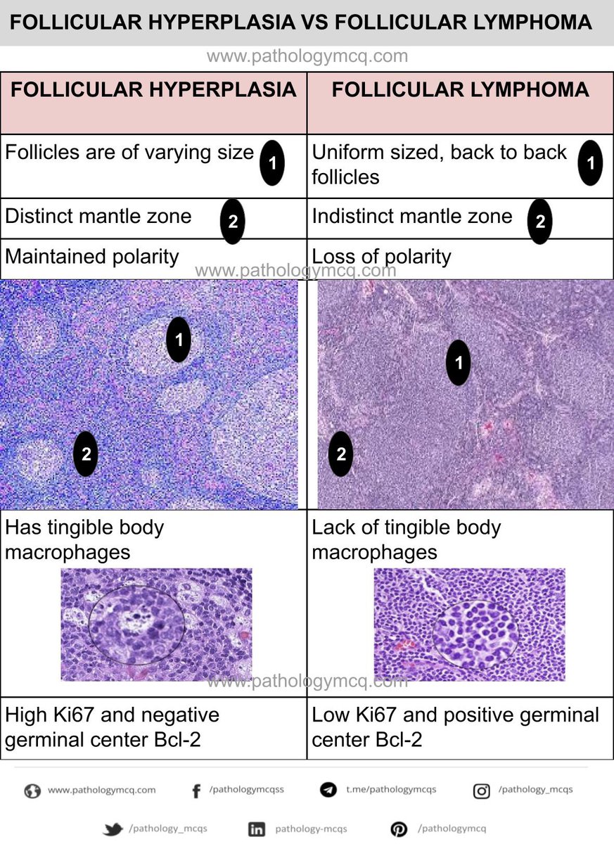 Follicular hyperplasia vs Follicular lymphoma.  #follicularhyperplasia #follicularlymphoma #lymphnode #hematopathology #bcl2