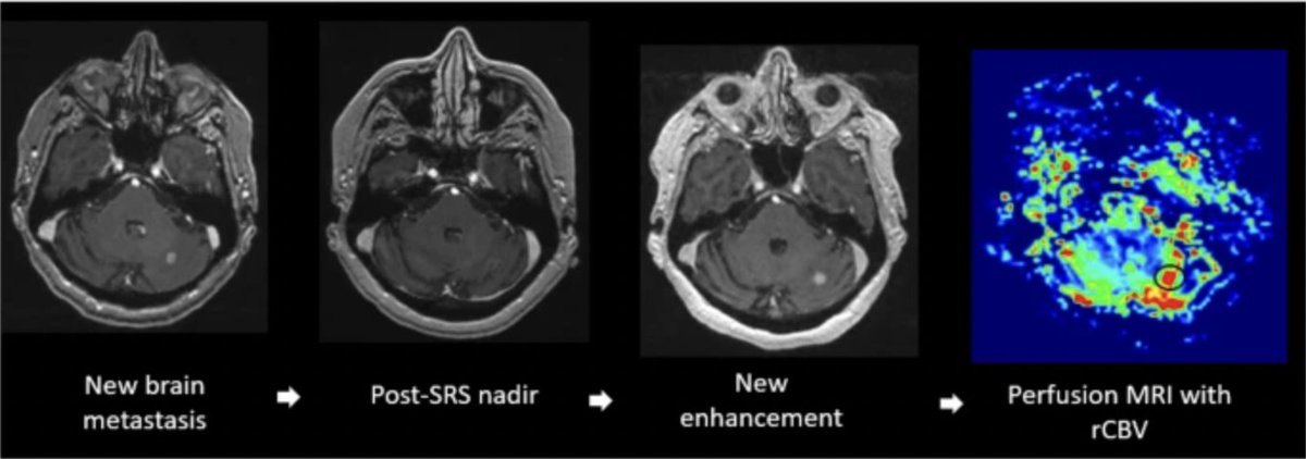 Journal of Neuro-Oncology (@jneurooncol) on Twitter photo It is challenging to distinguish between radiation necrosis and tumor progression on MRI. This recent literature review by <a href="/ZacharyMayoMD/">Zachary Mayo</a> <a href="/ClevelandClinic/">Cleveland Clinic</a> highlights additional imaging modalities helpful for diagnosis in this context <a href="/NSTumorSection/">NS Tumor Section</a>
link.springer.com/article/10.100… It is challenging to distinguish between radiation necrosis and tumor progression on MRI. This recent literature review by <a href="/ZacharyMayoMD/">Zachary Mayo</a> <a href="/ClevelandClinic/">Cleveland Clinic</a> highlights additional imaging modalities helpful for diagnosis in this context <a href="/NSTumorSection/">NS Tumor Section</a>
link.springer.com/article/10.100…