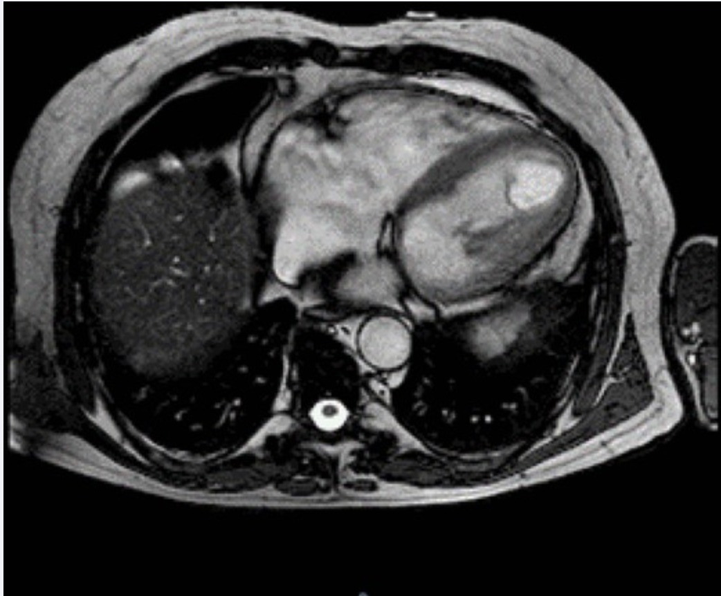 Looking for cardiac masses? 👀
See below ⬇️ academic.oup.com/eurheartjsupp/…
<a href="/ElisabettaBex/">Elisabetta Tonet</a> <a href="/LucaFileti/">Luca</a>