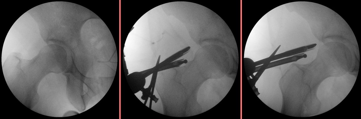 Bony bump (cam), before, during, and after resection.