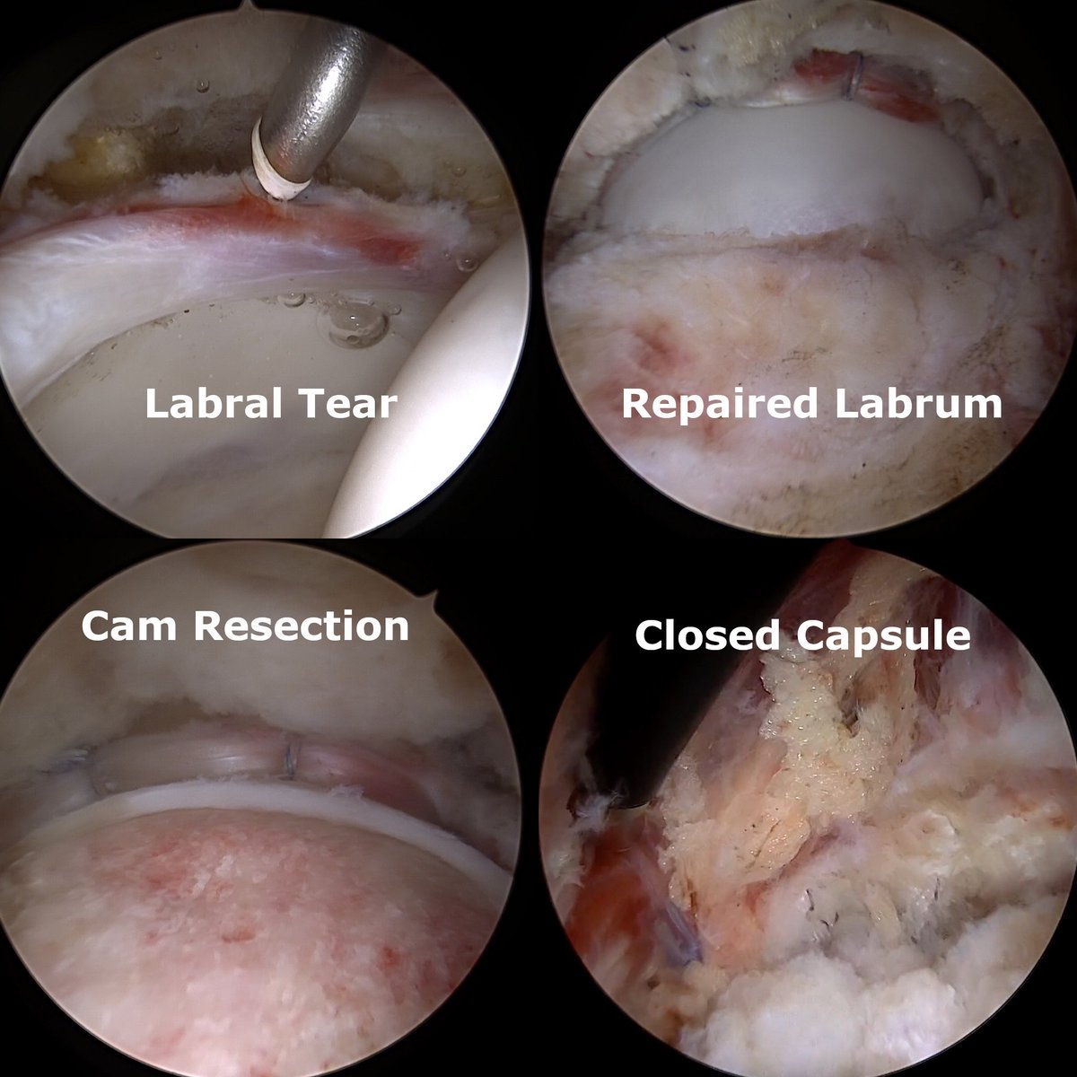 #HipPreservationResearch Sunday.

We aim to #RepairNotReplace.  Fix the labrum, remove the bony bump (cam), and close the capsule - restoring normal anatomy.