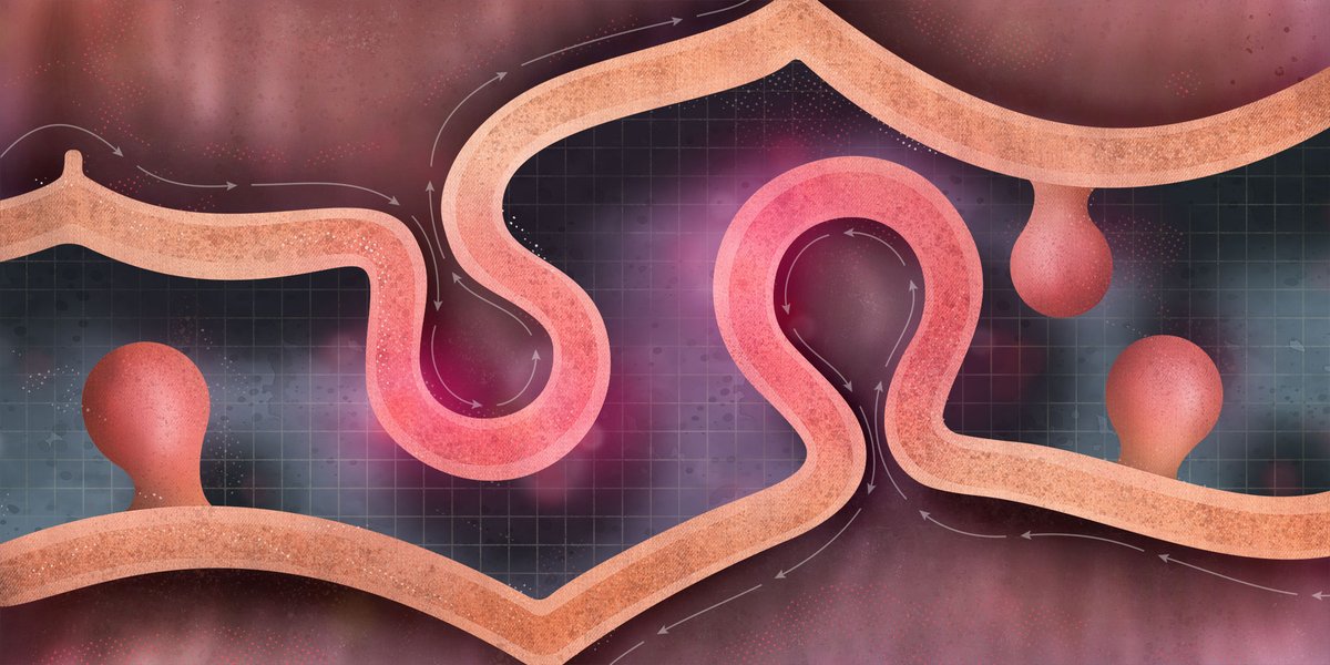 bpacnz (@bpacnz) on Twitter photo *New article* Diverticulitis: pockets of knowledge
bpac.org.nz/2023/diverticu…
#guthealth *New article* Diverticulitis: pockets of knowledge
bpac.org.nz/2023/diverticu…
#guthealth
