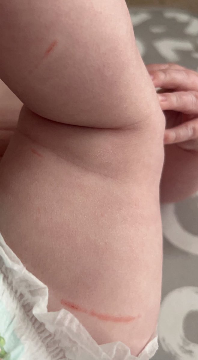ZoeNicol19's tweet photo. Don't change your baby at spoons in Wishaw 😭 whatever was on the changing table has scratched the life out of her little leg https://t.co/lru0NGD8WB