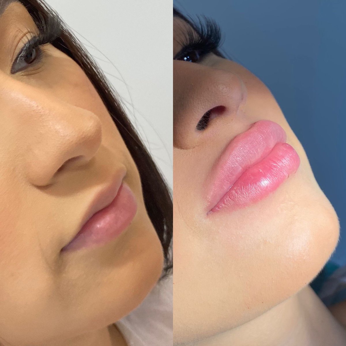 aylaoficia's tweet photo. Antes e o depois da minha boca https://t.co/PjntgqLo0O