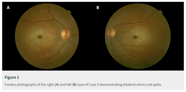 MichaelOkun's tweet photo. What does a cherry red spot look like? Ataxia, myoclonus, seizures; #neurotwitter and #nerdologists use your ophthalmoscope! Differential: central retinal occlusion Tay-Sachs, Sandhoff, Niemann-Pick, Fabry, Gaucher, and sialidosis. https://t.co/tHay5sedMF https://t.co/9oTGskJObp
