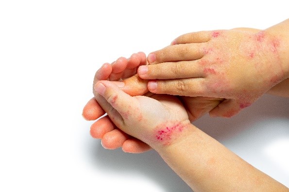 @theskinhospital Darlinghurst is looking for anyone aged between 12 and 17 for a new chronic hand #eczema clinical trial for those suffering from moderate to severe hand eczema. For further info, email clinicaltrials@skinhospital.edu.au  #eczemaresearch #atopicdermatitis