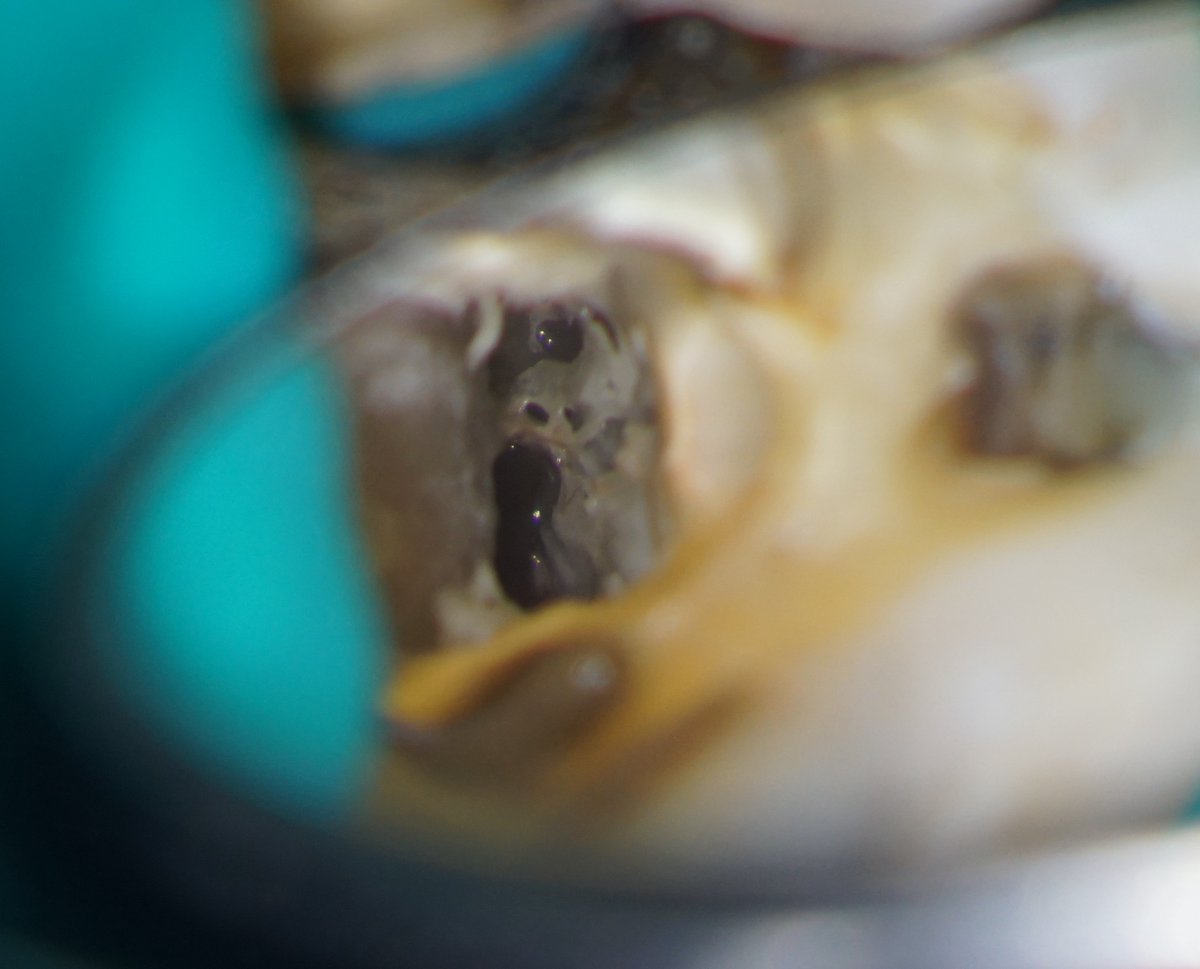 Managing a case of vital internal resorption LR6
youtu.be/oQbiKo3Rewc