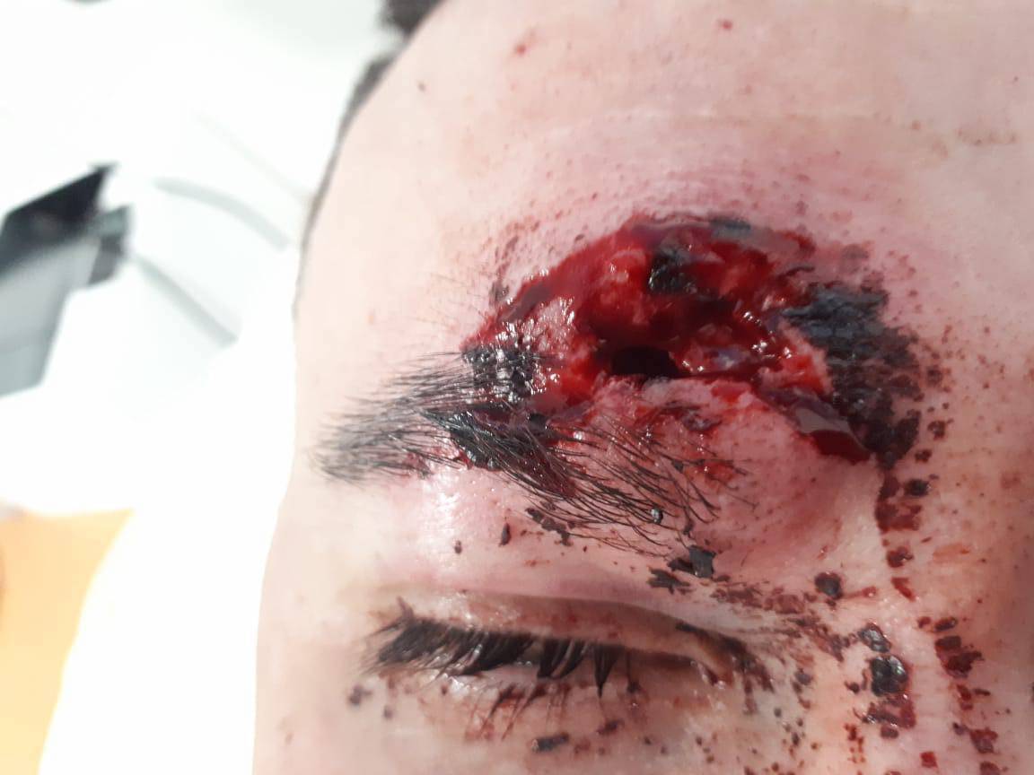 Bonjour <a href="/prefpolice/">Préfecture de Police</a> , le front de notre reporter interpellé jeudi dernier, placé en GAV pour "groupement en vue de commettre des violences"(lol) et libéré sans poursuite 24h plus tard. Faut-il prévoir des casques de moto demain ? #greve28mars #Brav-M #violencespolicieres