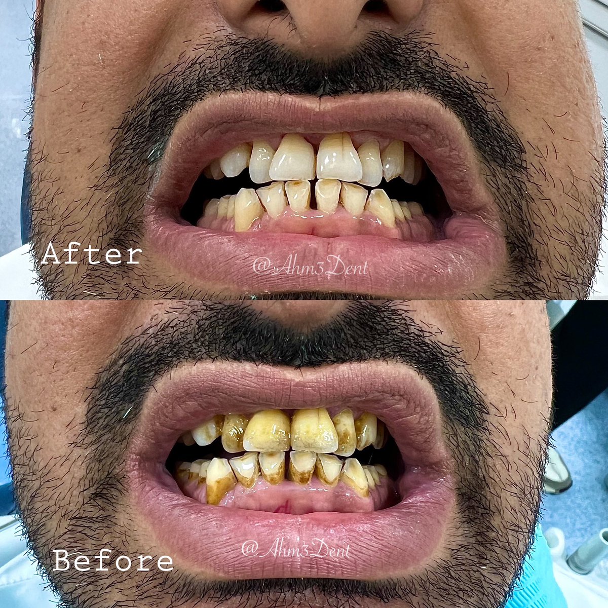 Ahm3dent's tweet photo. 38 year-old male patient came to the clinic complaining from the appearance of his smile .

Scaling and root planing was done on all of his teeth 🦷🪄 https://t.co/XB9a77HLIy