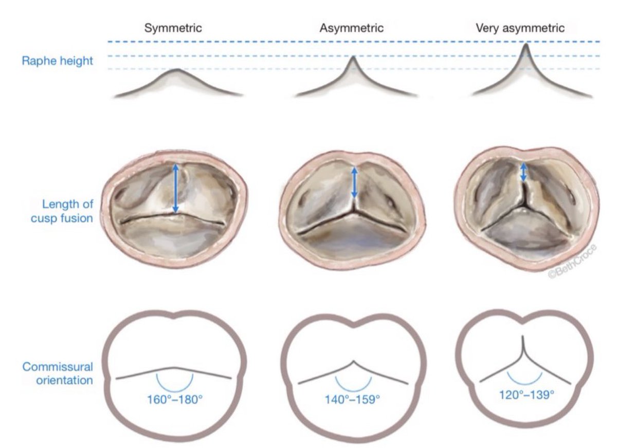 I have previously referred to this BAV classification as anatomical or surgical classification. But I want to give credit to the surgeons who have devised this classification. Hence, from now on, I will refer to this as the DeKerchove/El Khoury/Schäfers-classification. #aortaed