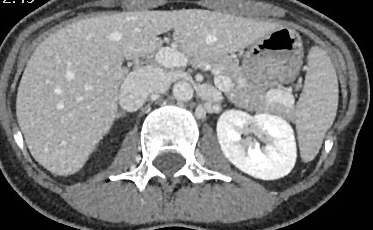 🙌🏻 Webinaire du <a href="/JURI_Fr/">Junior Radiologie Interventionnelle</a> ce soir 😎

🩻 Syndrome de congestion pelvienne avec le Pr <a href="/gsoulez/">Gilles Soulez</a> 

Patiente avec douleurs pelviennes chroniques. 
La phlébographie montre une incontinence de la veine gonadique gauche. 

Quel syndrome sous jacent suggère le scanner ?👇

<a href="/ETF_IRtrainees/">CIRSE European Trainee Forum</a>