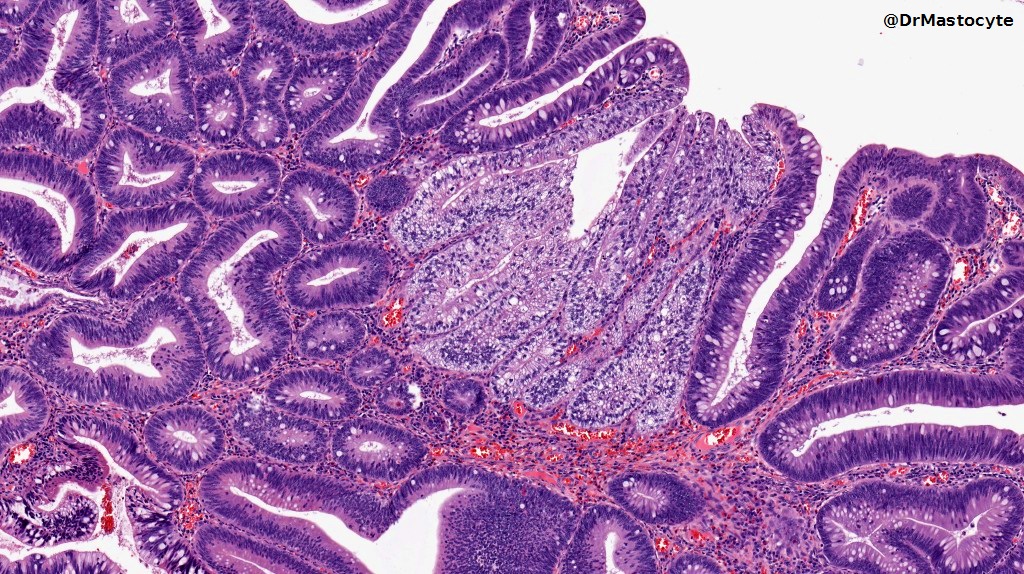 DrMastocyte's tweet photo. Tubulovillous adenoma of colon with clear cell change #GIpath #Pathology https://t.co/GDkeqg0vLj