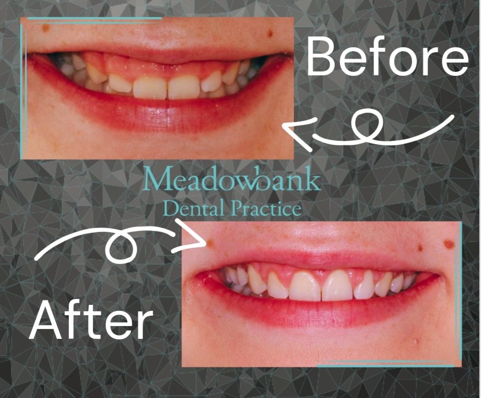 MeadowbankDP's tweet photo. After this lovely lady had her braces removed she was concerned about her gummy smile &amp; short teeth.
Here's the amazing results of her gum contouring 🤍 Book your  consultation on 01316595670
Fees apply
#Edinburgh #Dentist #smile #Meadowbank #TeamMDP #Periodontics #gumcontouring https://t.co/E61DUo6KoB