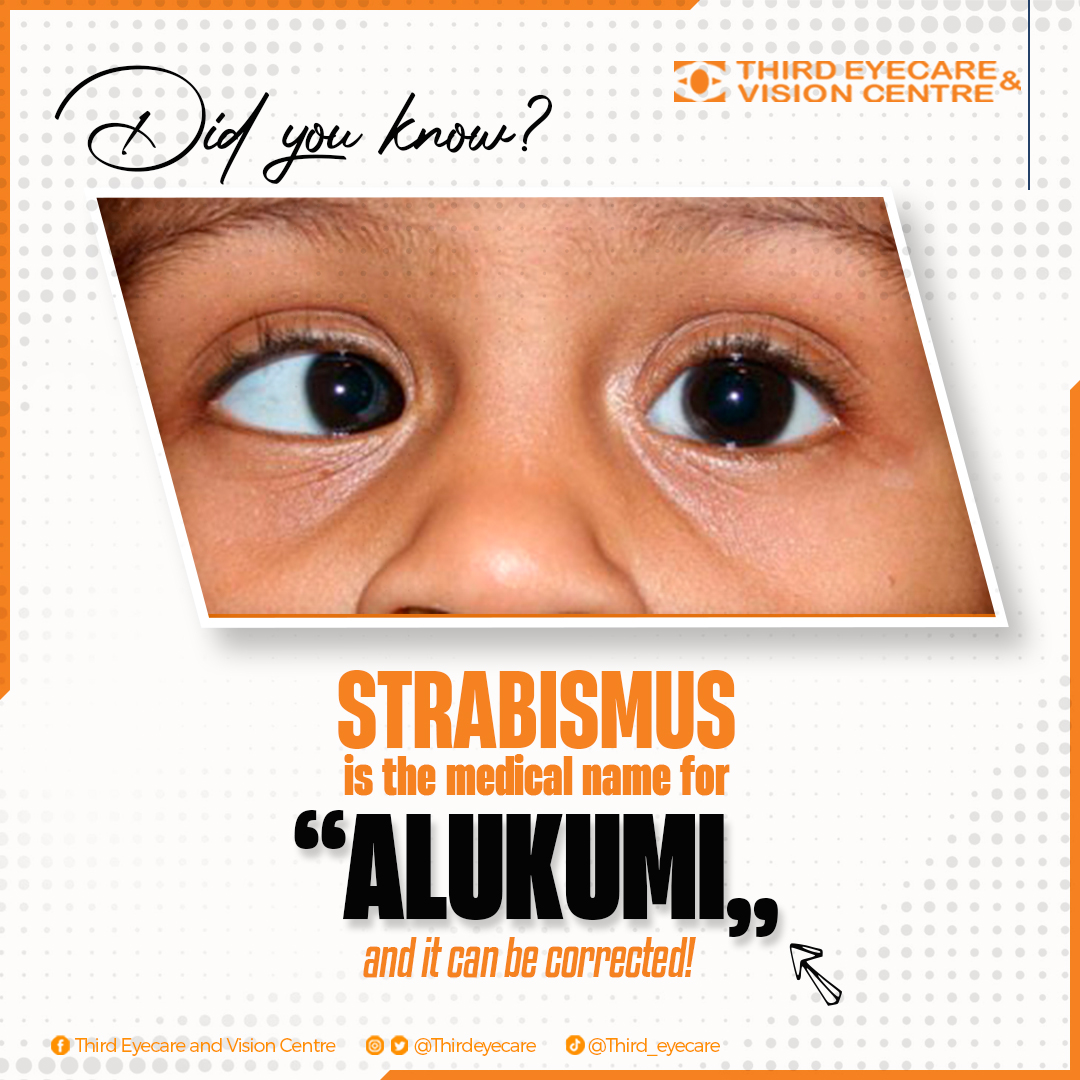 thirdeyecare's tweet photo. Did you know that crossed eyes (strabismus) can be treated? Come and see our Optometrists to help solve it.
#thirdeyecare #besteyeclinicinghana #ghana #alukumi #Strabismus
#CrossedEyes #EyeAlignment #VisionTherapy https://t.co/Lx3E7CHK32