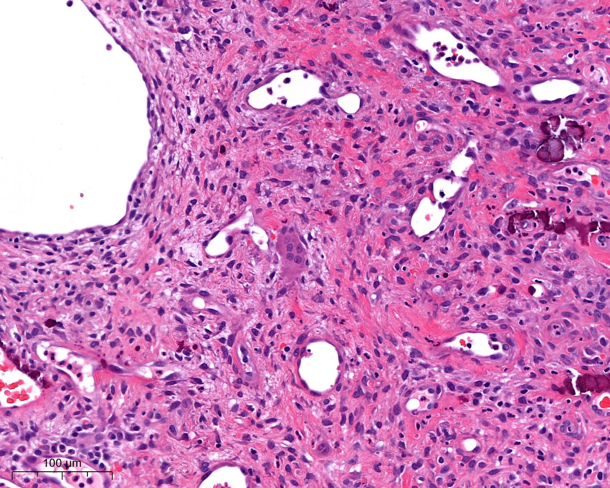 A. Polónia (@poloniaantonio) on Twitter photo Out of my comfort zone case - male, late 20s, gingival tissue 😃disclaimer: pic 4 was the only giant cell present <a href="/atman_ci/">Dr. Luca</a> <a href="/DrGeeONE/">Olaleke Folaranmi</a> <a href="/DrNishatAfroz2/">Nishat Afroz MD</a> <a href="/A_Morini_MD/">Aurélien Morini, MD, MSc 🇫🇷🇪🇺💙💛</a> <a href="/ariella8/">Celina Stayerman MD</a> <a href="/nusrat_xahra/">🔻Nusrat Zahra🔻🇵🇸</a> <a href="/amalasar86/">Amal Asar, FRCPath, MAcadMED</a> <a href="/gonzadetoro/">Gonzalo De Toro</a> <a href="/TristanRutland7/">Tristan Rutland MBBS FRCPA IFCAP</a> <a href="/LoboAnandi/">Anandi Lobo, MD</a> <a href="/SumantaDas_7/">Sumanta Das</a> <a href="/kis_lorand/">Lorand Kis</a> <a href="/JPintoPath/">João Correia Pinto</a> Out of my comfort zone case - male, late 20s, gingival tissue 😃disclaimer: pic 4 was the only giant cell present <a href="/atman_ci/">Dr. Luca</a> <a href="/DrGeeONE/">Olaleke Folaranmi</a> <a href="/DrNishatAfroz2/">Nishat Afroz MD</a> <a href="/A_Morini_MD/">Aurélien Morini, MD, MSc 🇫🇷🇪🇺💙💛</a> <a href="/ariella8/">Celina Stayerman MD</a> <a href="/nusrat_xahra/">🔻Nusrat Zahra🔻🇵🇸</a> <a href="/amalasar86/">Amal Asar, FRCPath, MAcadMED</a> <a href="/gonzadetoro/">Gonzalo De Toro</a> <a href="/TristanRutland7/">Tristan Rutland MBBS FRCPA IFCAP</a> <a href="/LoboAnandi/">Anandi Lobo, MD</a> <a href="/SumantaDas_7/">Sumanta Das</a> <a href="/kis_lorand/">Lorand Kis</a> <a href="/JPintoPath/">João Correia Pinto</a>