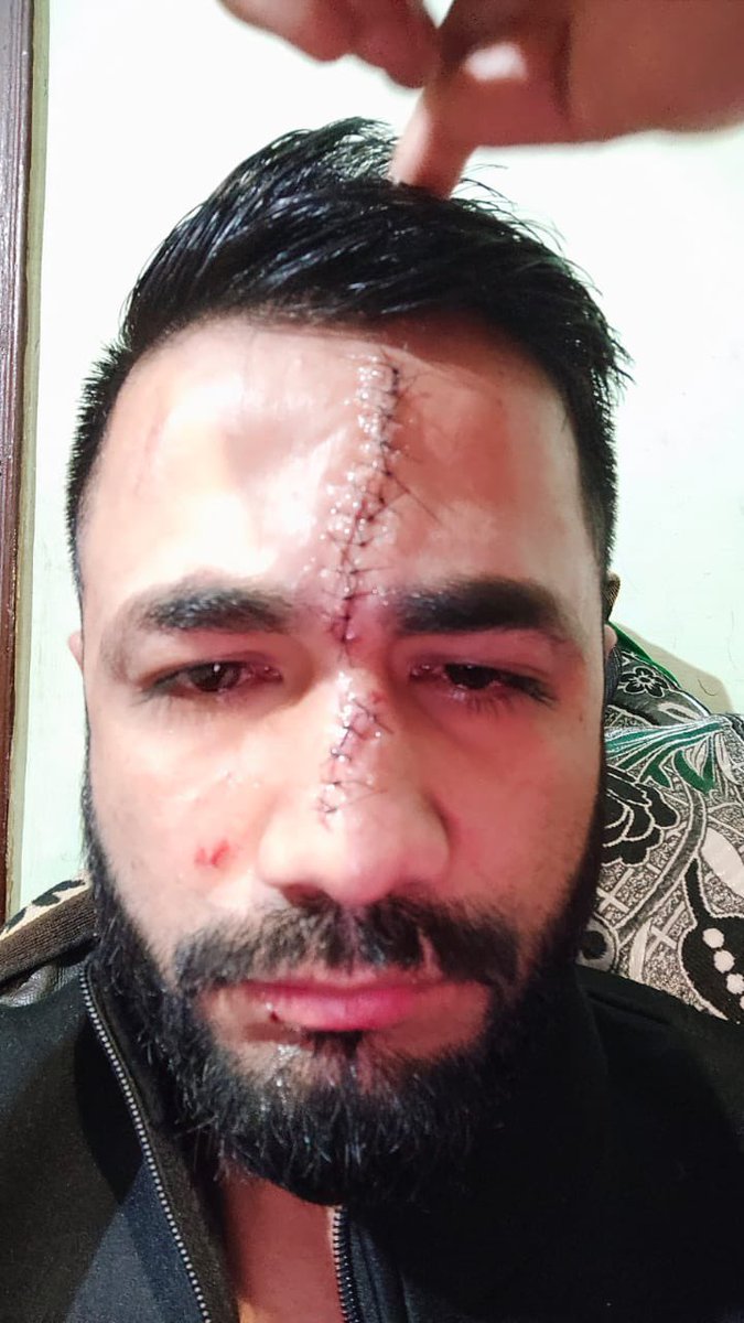 KumaarSaagar's tweet photo. साकेत में काम करने वाले एक बार में मामूली सी कहासुनी पर हिंदू युवक रमेश पर तौमीर मंसूर ने तेज धारधार हथियार से बाहर से लड़के बुला कर किया जानलेवा हमला।

FIR दर्ज लेकिन लेकिन तौमीर दिल्ली पुलिस की गिरफ़्त से बाहर।

@CPDelhi @LtGovDelhi @HMOIndia https://t.co/GV5g0t6P6X