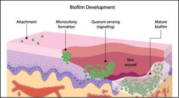 Peri wound skin should be cleansed 20cm around the wound or the full limb under a bandage.

It leads to:
-Improved healing
-Decreased infection risk
-Reduced dressing frequency and associated cost
-Reduced pain and discomfort
Improved quality of life 
(Woo et al, 2017).