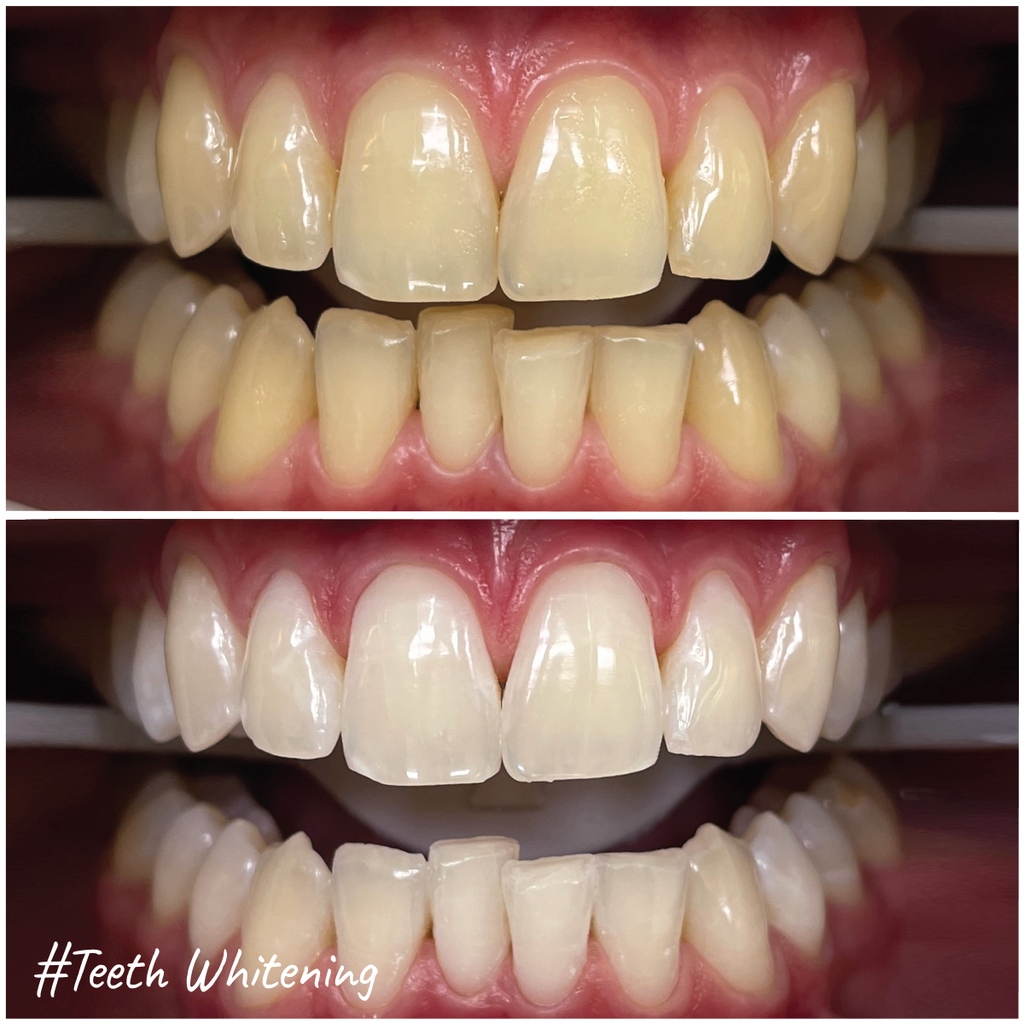 MicrisDental's tweet photo. Fight stubborn #Stains with #TeethWhitening!🦷💪

Under the professional care of #DentalExperts like our #DentalHygienist Jenna Jodrey (RDH), teeth whitening can help you achieve a #BrightSmile without sacrificing any of your #ToothStructure.😃🤍

Rate this #SmileMakeover!⬇️ https://t.co/J6EkMKuYS0