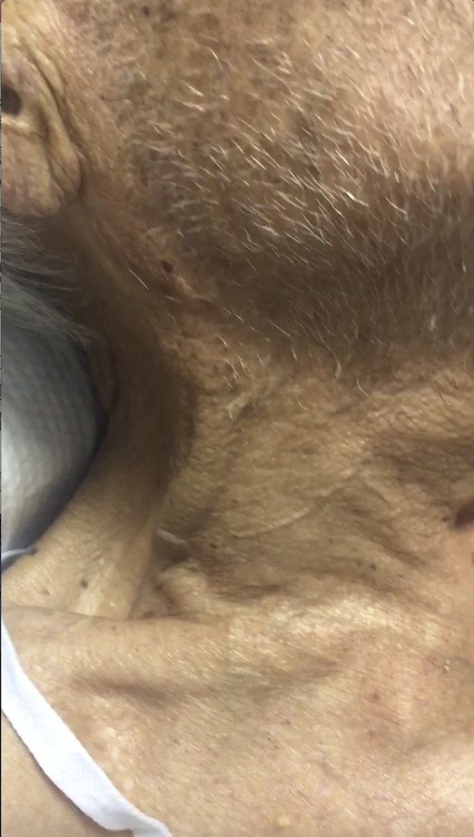 ACEPNation's tweet photo. #FOAMed Case: "Elderly Male With Shortness of Breath" https://t.co/cdZXumvFvI
• 87-year-old man presented with shortness of breath without chest pain, palpitations, or diaphoresis
• He had a history of atrial fibrillation with a previous left atrial thrombus https://t.co/W622sPl6ih