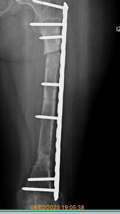 Mi hija es de Maracaibo ella se encuentra en proceso de rehabilitación en el Hogar Clínica San Rafael de Maracaibo luego de su tercera cirugía...quién pueda apoyarla a continuar con su proceso le agradecería infinitamente. Ella es sobreviviente de cancer de fémur.