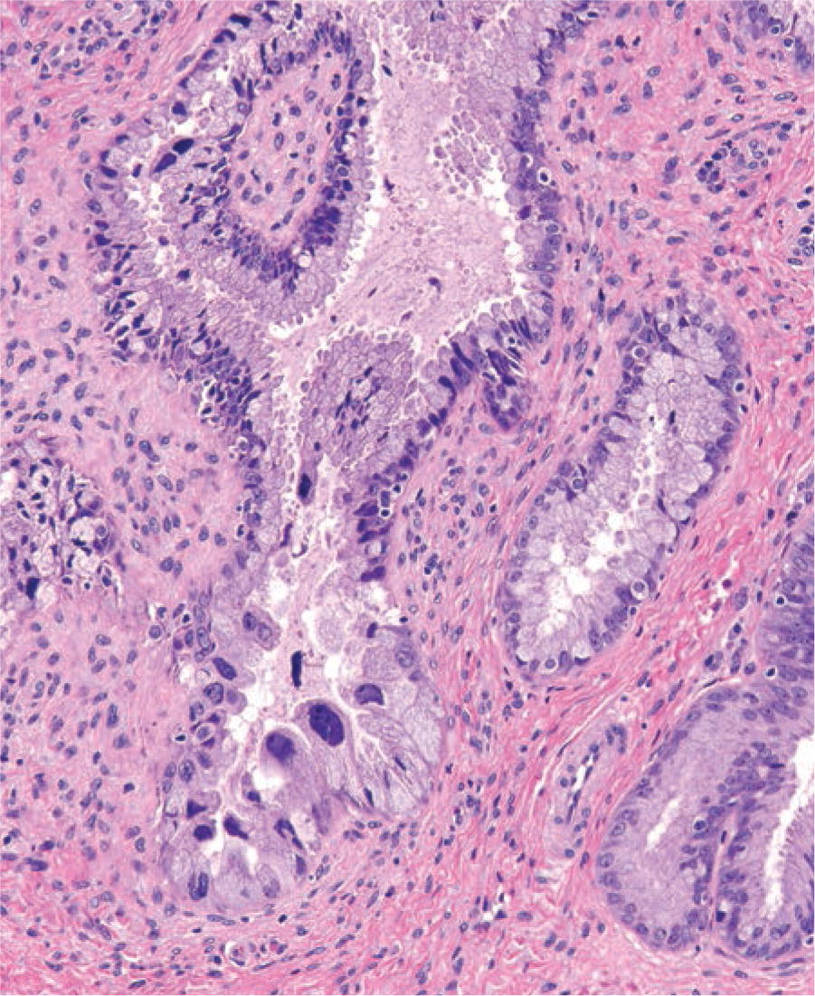 ARP Press on Twitter "Cervix AriasStella reaction (ASR) isn't just