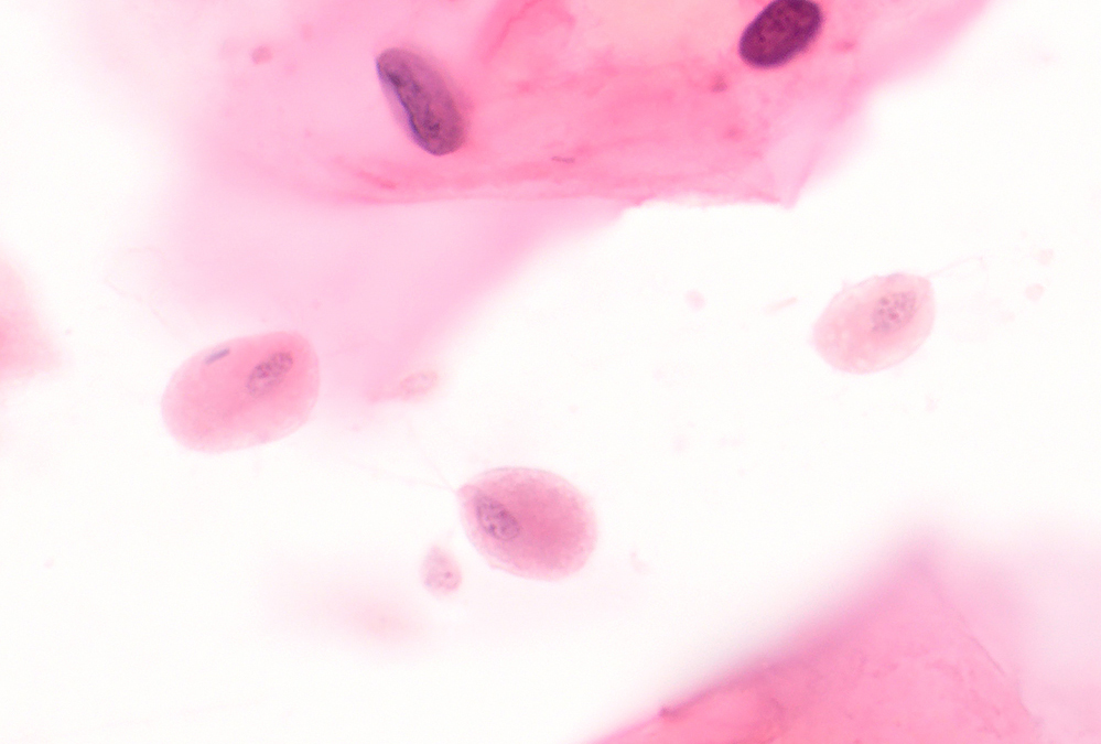 ParasiteGal's tweet image. From the archives – 3 different preps of the same parasite in vaginal secretions: parasitewonders.blogspot.com/2023/03/case-o… (conventional smear, ThinPrep, and Giemsa Cytospin) Which one is your favorite? #mayopath #pathology #IDPath #CrittersOnTwitter #PathBugs