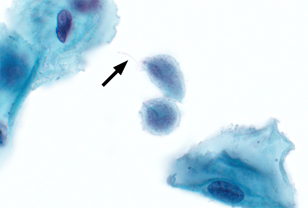 ParasiteGal's tweet image. From the archives – 3 different preps of the same parasite in vaginal secretions: parasitewonders.blogspot.com/2023/03/case-o… (conventional smear, ThinPrep, and Giemsa Cytospin) Which one is your favorite? #mayopath #pathology #IDPath #CrittersOnTwitter #PathBugs