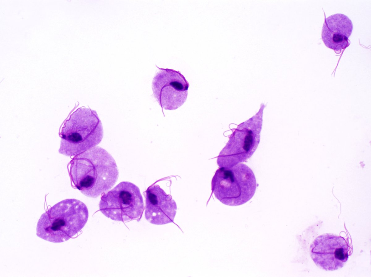 ParasiteGal's tweet image. From the archives – 3 different preps of the same parasite in vaginal secretions: parasitewonders.blogspot.com/2023/03/case-o… (conventional smear, ThinPrep, and Giemsa Cytospin) Which one is your favorite? #mayopath #pathology #IDPath #CrittersOnTwitter #PathBugs