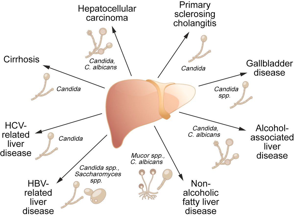 Did you know that FUNGAL products favor fatty liver and liver cancer ? This emerging role of Candida and fungal products represents novel targets for therapy. See this review by @Bernd_Schnabl in @JHepatology bit.ly/40i2EUF #livertwitter #MedTwitter @EASLedu