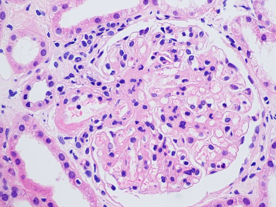 carles_saus's tweet photo. ⚡️Cholesterol crystal emboli 
✍️Glomerular colesterol microemboli , rare , easy to miss (usually  seen in intelobular or arcuate arteries )
✍️Multisystemic disease 
🏥Usually  iatrogenic 
🧠🦶👁️Clinical  presentation diverse 
💣Poor long-term outcomes
#pathology #kidneydisease https://t.co/mG6BkAuL4K