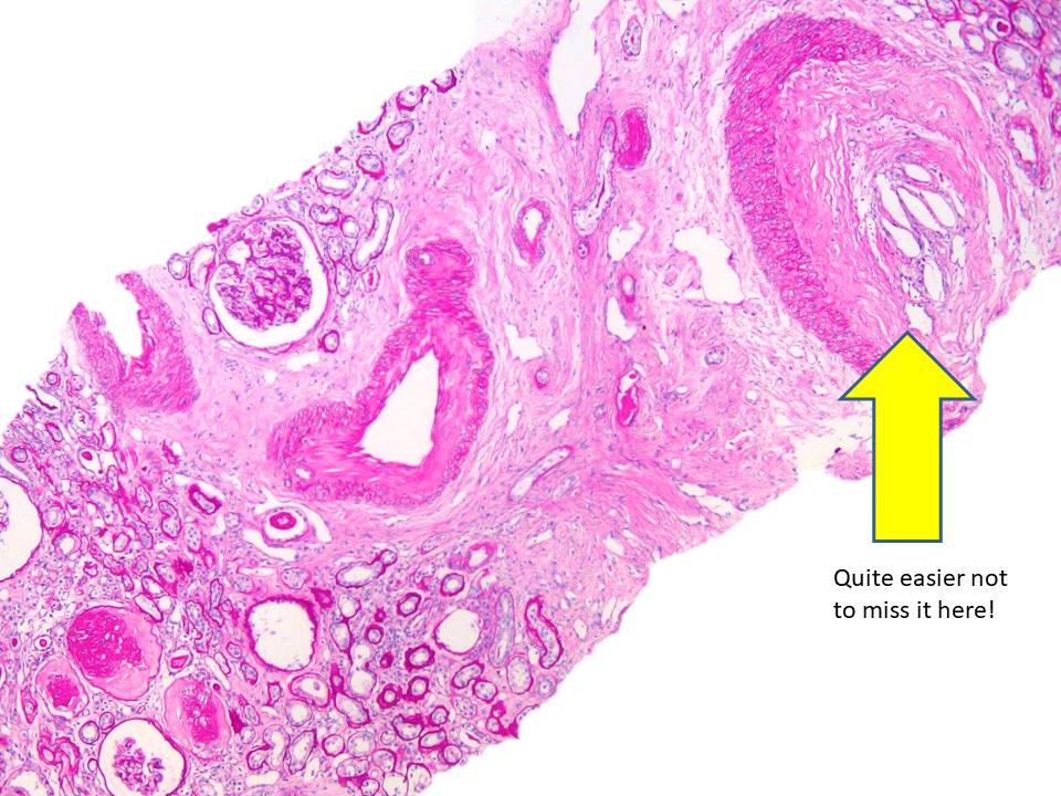 carles_saus's tweet photo. ⚡️Cholesterol crystal emboli 
✍️Glomerular colesterol microemboli , rare , easy to miss (usually  seen in intelobular or arcuate arteries )
✍️Multisystemic disease 
🏥Usually  iatrogenic 
🧠🦶👁️Clinical  presentation diverse 
💣Poor long-term outcomes
#pathology #kidneydisease https://t.co/mG6BkAuL4K
