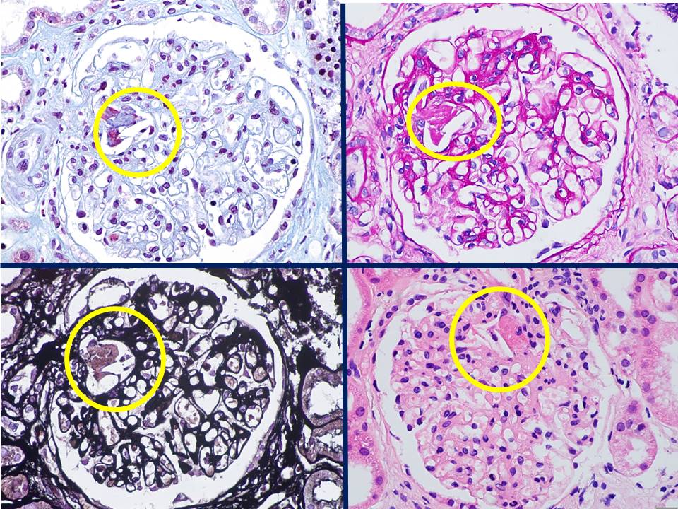 carles_saus's tweet photo. ⚡️Cholesterol crystal emboli 
✍️Glomerular colesterol microemboli , rare , easy to miss (usually  seen in intelobular or arcuate arteries )
✍️Multisystemic disease 
🏥Usually  iatrogenic 
🧠🦶👁️Clinical  presentation diverse 
💣Poor long-term outcomes
#pathology #kidneydisease https://t.co/mG6BkAuL4K