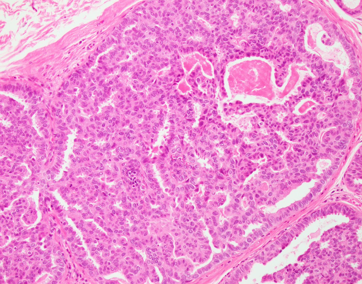 fouad_boulos's tweet photo. Welcome to my Twitter account where I will be sharing my experience and thoughts from difficult cases received on the WASHU breast consultation service. Questions and comments always welcome. We learn together. #PathTwitter #BreastPathology @wusm_pathology @washupathedu https://t.co/ImmdmpzsQo
