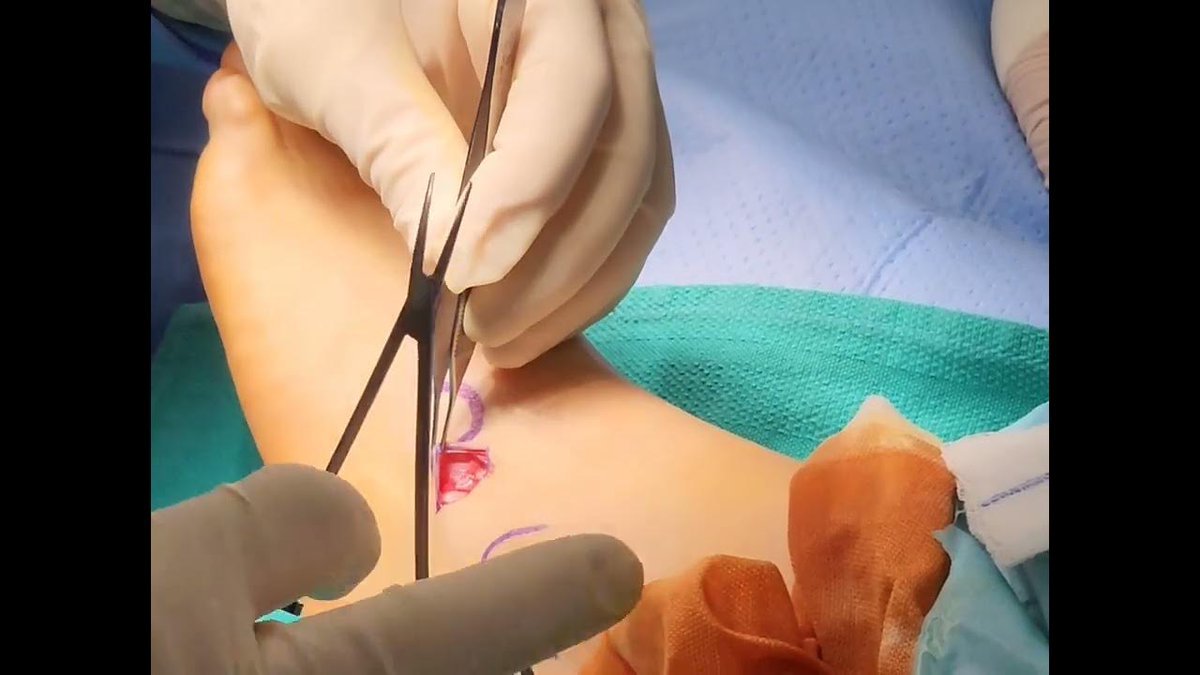 HyProCure's tweet photo. "Hyprocure procedure" - Dr. Elie C. Daniel
https://t.co/2fPx5WMScd
#hyprocure #alignmyfeet #mislaignedfeet #footandankle #footpain #flatfeet #flatfoot #footsurgery https://t.co/dp88PtB1ba