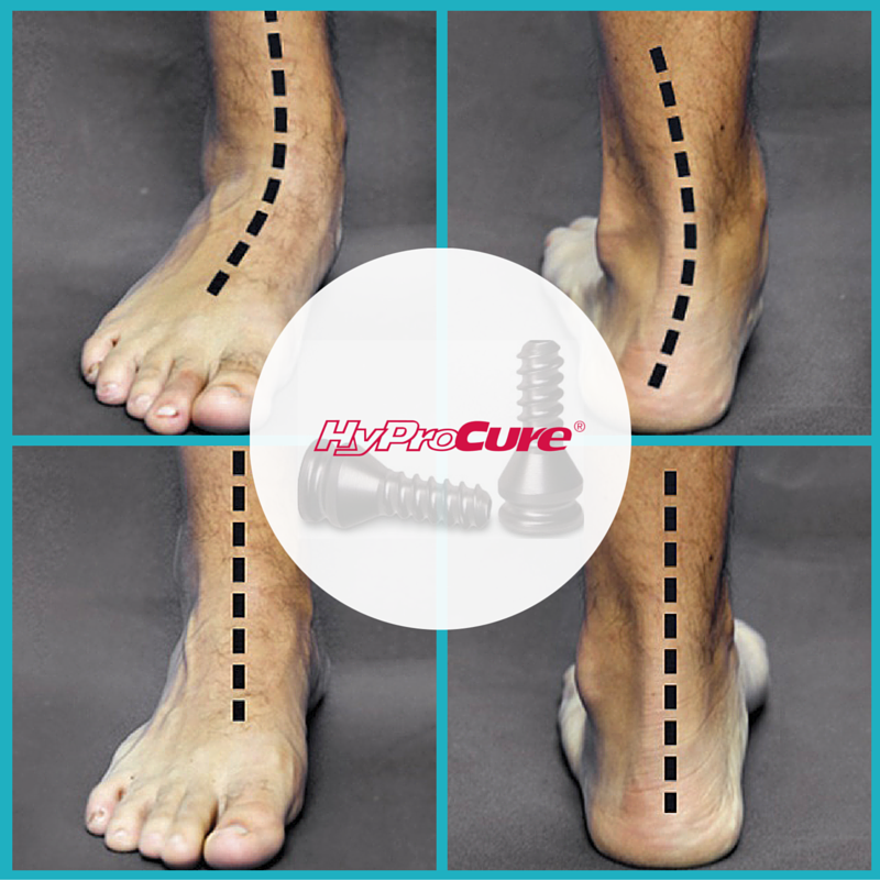 Talotarsal dislocation is a common condition affecting millions of people of all ages throughout the world. It occurs when the ankle bone displaces off of its normal position and its contact points on the hind-foot bones.  ow.ly/SWGH50N8tXo #atlasfai #footpain #flatfeet