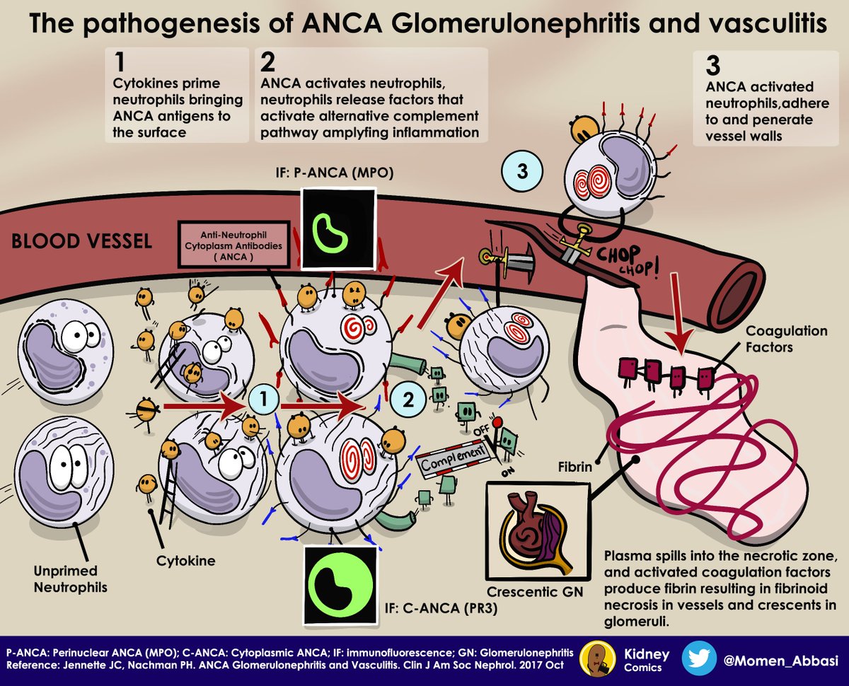 Kidney Comics: The Pathogenesis of ANCA Associated Vasculitis  @momen_abbasi renalfellow.org/2023/03/27/kid…