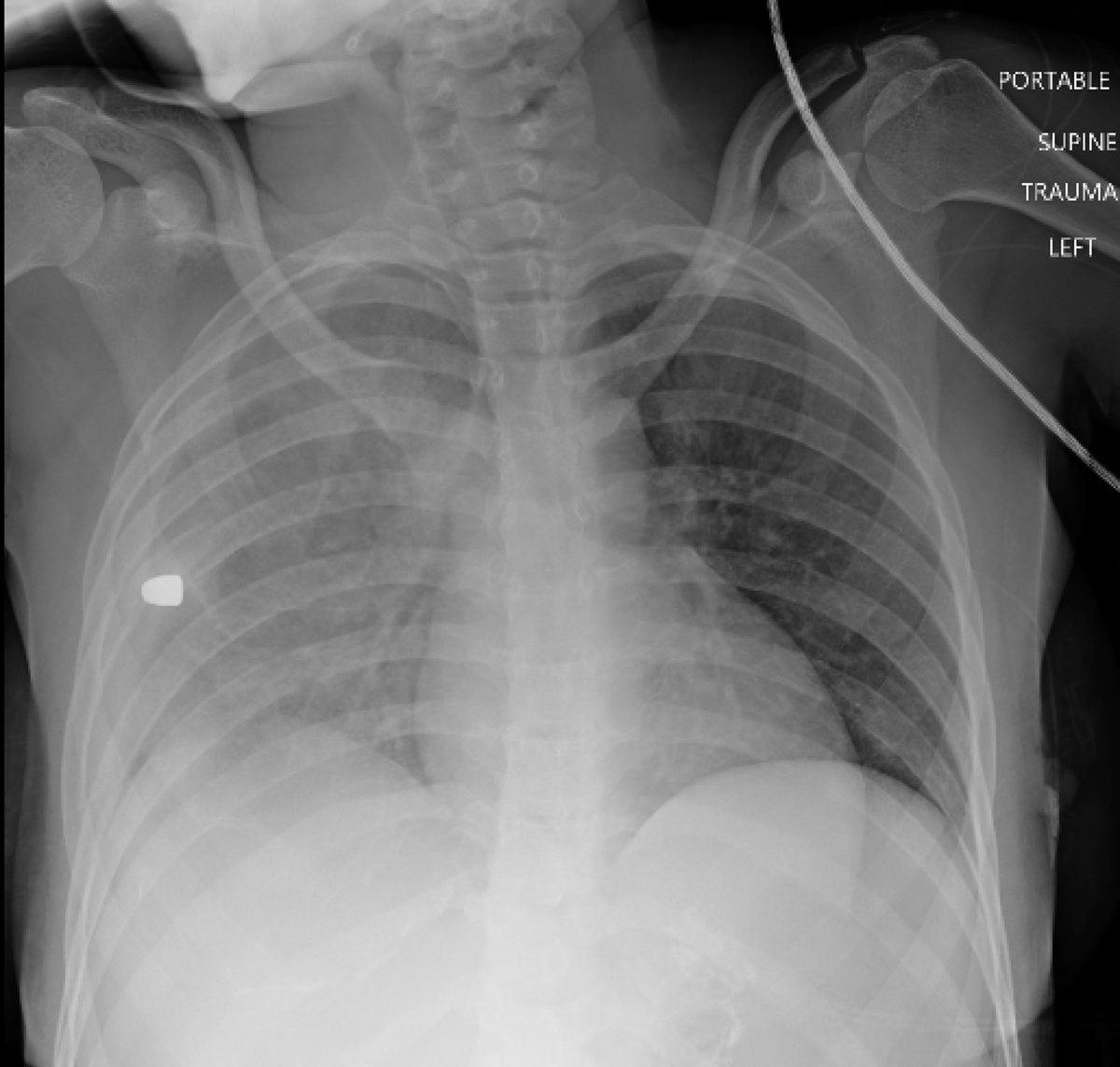 Here’s the Chest X-Ray of a young girl suffering from a condition that is now the #1 cause of death in children and adolescents in the U.S. What’s the diagnosis?