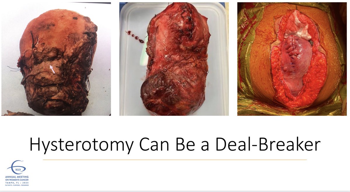 AllisonSaizMD's tweet image. Why are #GynOncs discussing Placental Accreta Spectrum disorders?  We are increasing involved in these patients’ care and multidisciplinary involvement saves lives.  Thanks to Drs. McCann, @fkcollado, and @bossmd for sharing the experience of your institutions. #SGOMtg #PAS