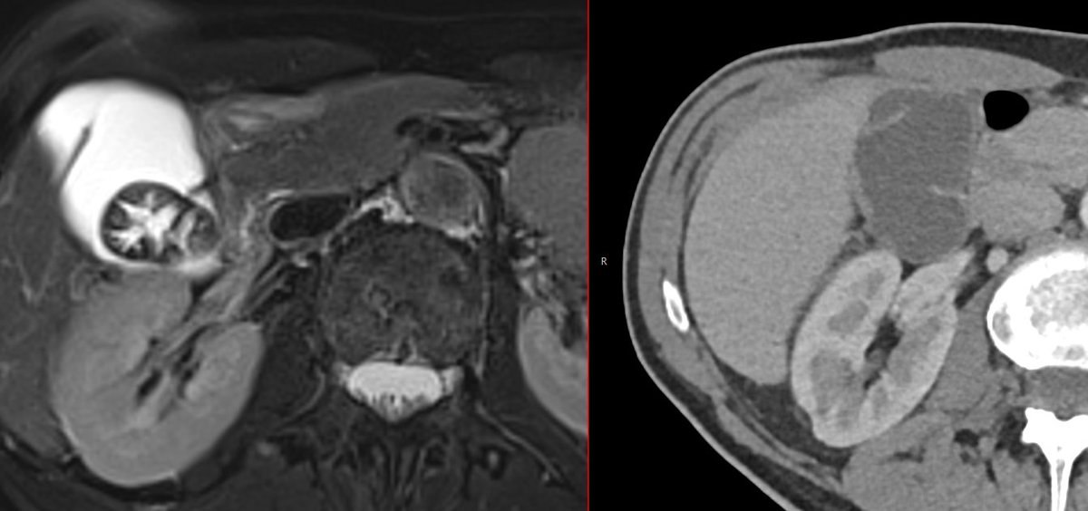 xsectional's tweet photo. When it comes to the gallbladder, MRI is always superior: https://t.co/K2hqm4j0xA
