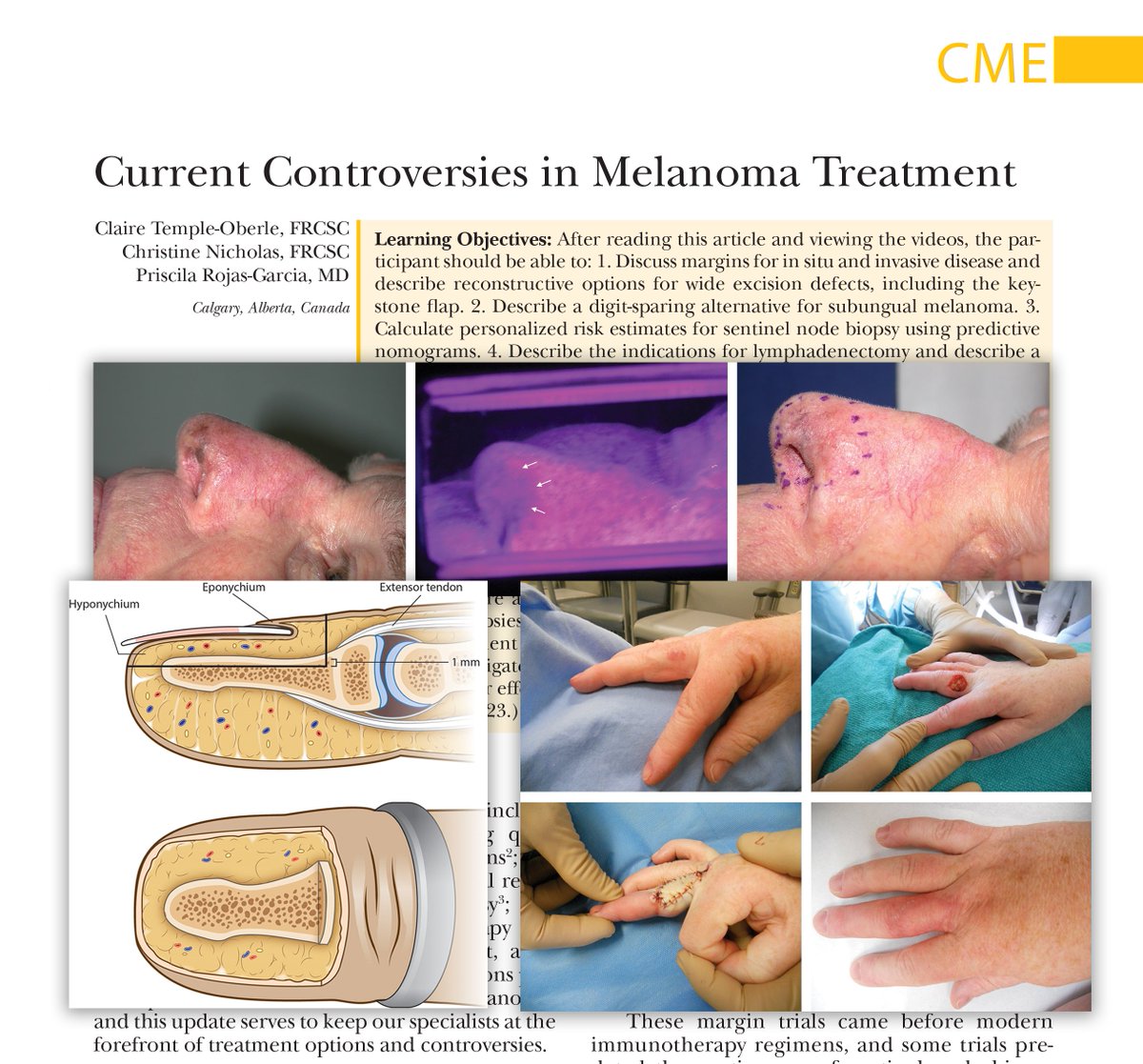 #Melanoma management continues to evolve, and #plasticsurgeons need to stay at the forefront of advances and controversies. Read and watch, "Current Controversies in #MelanomaTreatment" by Temple-Oberle, Nicholas, and Rojas-Garcia.
bit.ly/MelanomaTreatm…