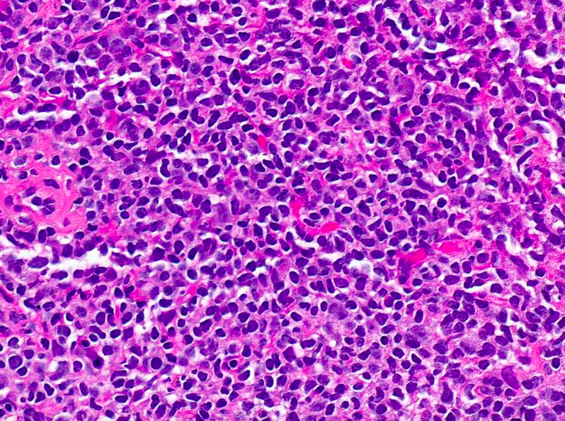 SibaElHussein's tweet photo. Mantle cell lymphoma with plasma cell differentiation in the lung➡️
🩸Easy to misdiganose as marginal zone lymphoma
🩸CD5 homogeneous (+) highlights the possibility of Mantle cell lymphoma
🩸Typically Cyclin D1(+)/SOX11(-)
🩸Indolent clinical course

#hemepath #lymsm #PathTwitter https://t.co/i2eT3ConKF