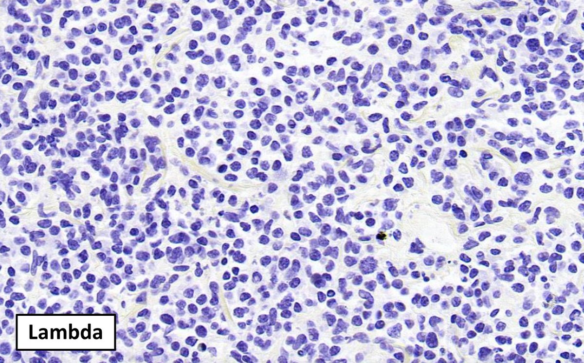 SibaElHussein's tweet photo. Mantle cell lymphoma with plasma cell differentiation in the lung➡️
🩸Easy to misdiganose as marginal zone lymphoma
🩸CD5 homogeneous (+) highlights the possibility of Mantle cell lymphoma
🩸Typically Cyclin D1(+)/SOX11(-)
🩸Indolent clinical course

#hemepath #lymsm #PathTwitter https://t.co/i2eT3ConKF