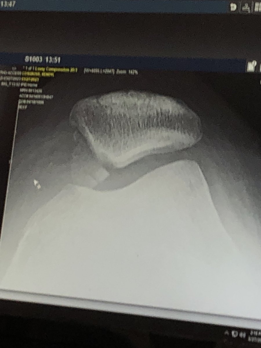 SpookyKyd's tweet photo. Besties I’m begging you if you go thrifting tomorrow please please please keep an eye out for a wheel chair for me! I will venmo you. I have a broken knee cap and cannot get around without it for the distances I need to “walk”. Plz share if you can. https://t.co/59NVbXP4ta