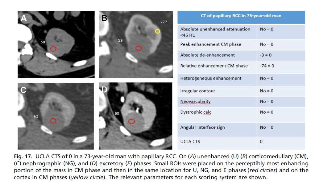 Radiologist’s Disease: Imaging for Renal Cancer 
sciencedirect.com/science/articl… 
🔵A must read article on imaging-based characterization of renal masses by Dr. Alex Chung and Dr. <a href="/StevenSRaman_MD/">Steven S. Raman MD, FSAR, FSIR</a> 
👍Thank you for this nice paper
#radiology #medtwitter #CancerResearch