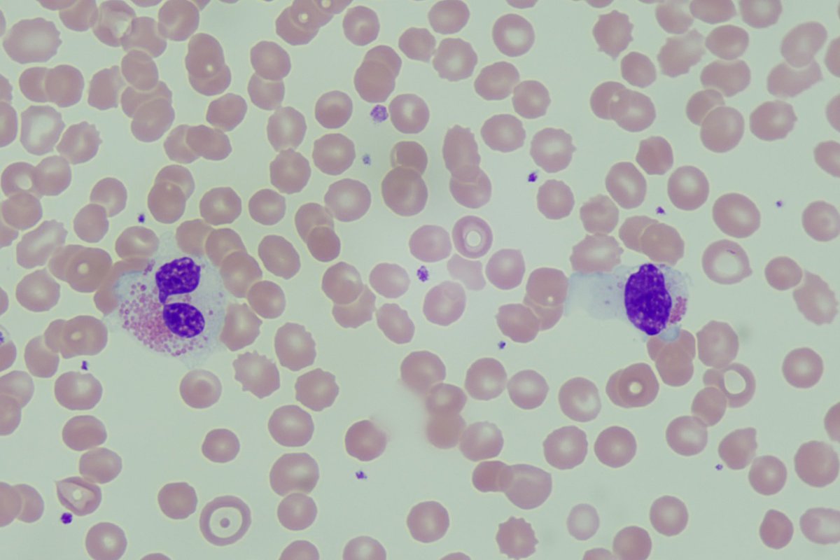 diff_discussion's tweet image. An interesting case of ALL that presented with eosinophilia in the peripheral blood but no blasts youtu.be/q0BmSV4pLYY