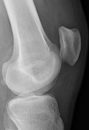 UW_MSKrad's tweet photo. #CaseOfTheWeek ‼️🎉‼️

☢️🩻☠️Case #13☠️🩻☢️
 
Another knee coming your way! 
#KneePain🦴🩻🤕

➡️➡️➡️Diagnosis❓🧐🔍🧩

#MSKRad #FOAMrad #radres #MedEd #RadEd #OrthoTwitter #SportsOrtho @ssr_rwg @UWRadRes @AOSSM_SportsMed https://t.co/MPucHPzFPb