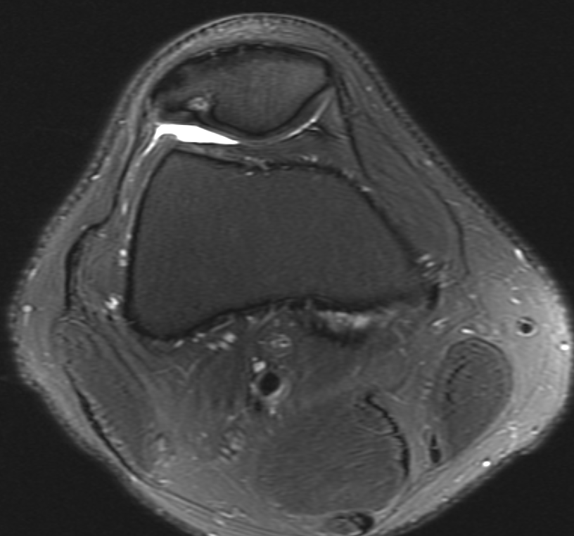 UW_MSKrad's tweet photo. #CaseOfTheWeek ‼️🎉‼️

☢️🩻☠️Case #13☠️🩻☢️
 
Another knee coming your way! 
#KneePain🦴🩻🤕

➡️➡️➡️Diagnosis❓🧐🔍🧩

#MSKRad #FOAMrad #radres #MedEd #RadEd #OrthoTwitter #SportsOrtho @ssr_rwg @UWRadRes @AOSSM_SportsMed https://t.co/MPucHPzFPb